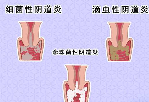 阴道分泌物黄瓜视频成人A片免费观看剖析什么是细菌性阴道炎