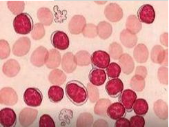 白带常规在线观看黄瓜视频检测鳞状上皮细胞增生的病症