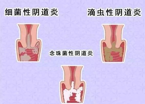 全自动阴道分泌物黄瓜视频成人A片免费观看厂家提醒您还在拖延吗，还在等阴道炎自愈吗？